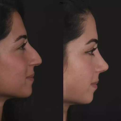 Rhinoplasty in Dubai