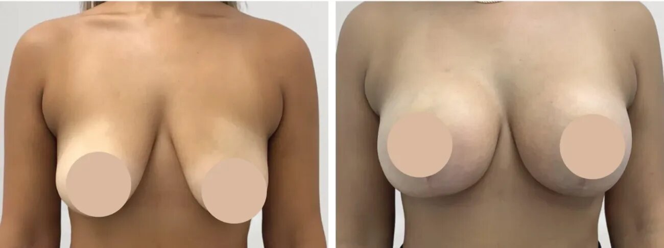 breast reduction in Dubai
