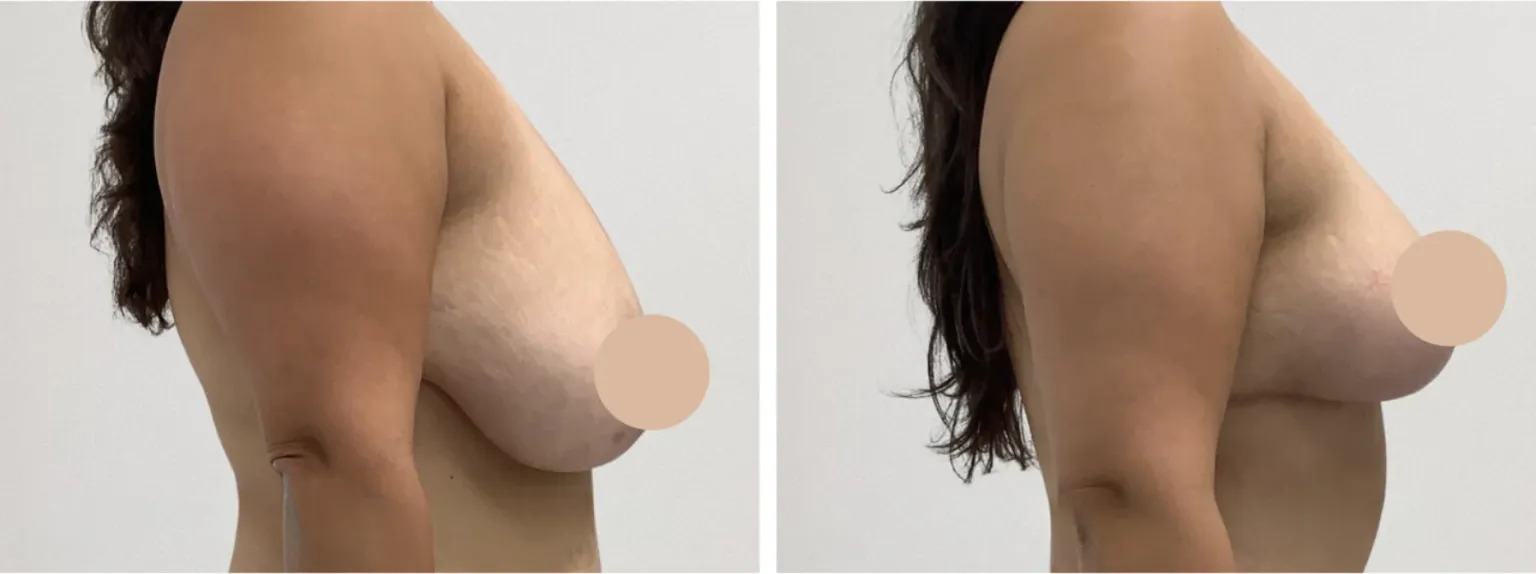 Breast Lift