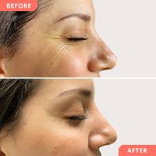 Bahnhofstrasse Botox