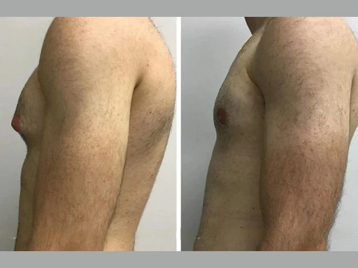 Gynecomastia Surgery in Dubai