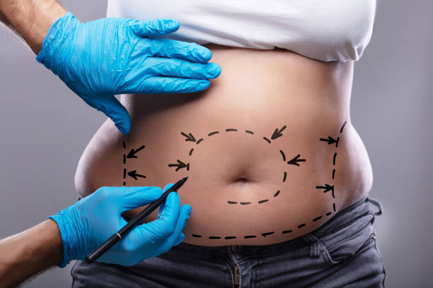 Liposuction surgery in Dubai